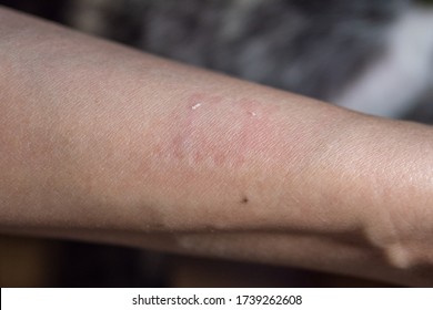 Small Dog Bite Mark On Woman Arm 