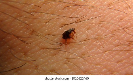 typhus fever