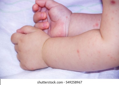 A Small Hand Of Child Covered By Eczema. Allergy Baby Skin Dermatitis Food. Unrecognizabledermatitis Symptom Problem Rash. Face Sleeping Newborns. Suffering Atopic On Skin Cheeks. Concept Child Health