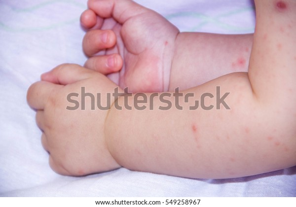 小さな手の子どもが湿疹を出している 赤ちゃんアレルギー皮膚炎食品 認識不能皮膚炎の症状は発疹 寝ている新生児の顔を 肌の頬にアトピー性の苦しみを感じる 子どもの健康を考える の写真素材 今すぐ編集