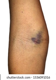 Small Intravenous Injection Brusie Or Haematoma Beside Basilic Vein At Elbow Joint Area Of Right Skinny Forearm In Thin Alcoholic Adult Man Patient With Malnutrition. It Is Complications Of Injection.