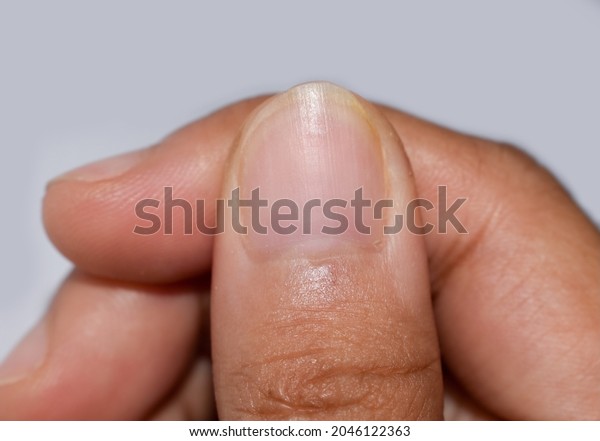 Small or missing lunula or
half-moons at fingernail with longitudinal lines in Asian young
woman.
