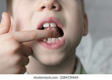 small patient, child, boy 7 years opened mouth touches tip tongue, performs therapy exercises, speech disorders, correction, frenum of tongue, develop skills like comprehension, communication problems