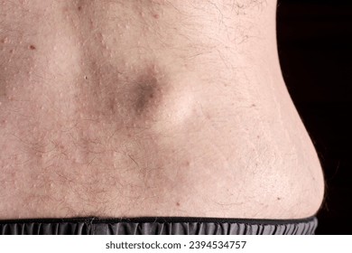 Small round lipoma on the lower back of young caucasian man against dark black background. - Shutterstock ID 2394534757