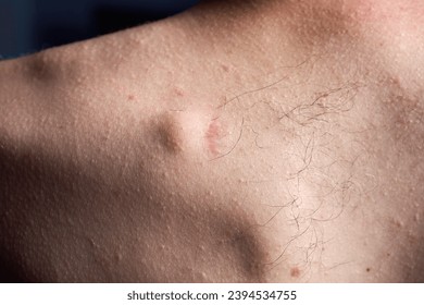 Small round lipoma on the upper back of young caucasian man. The lipoma is next to the scar left by a previous lipoma that became infected and dissolved. - Shutterstock ID 2394534755