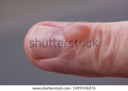 Small round or oval bumps on a finger near a nail. In latin: Myxoid cyst also called a digital mucous cyst or mucous pseudocyst. Twice as many women as men are affected. Top view. Image