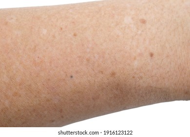 Hypomelanosis Images Stock Photos Vectors Shutterstock