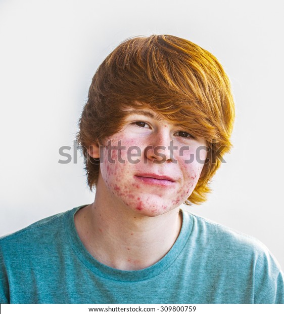 Smart Happy Boy Puberty Acne Stock Photo (Edit Now) 309800759