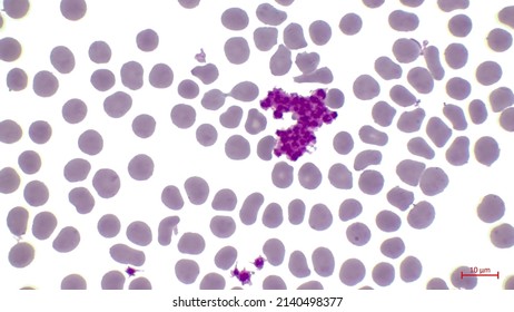 A smear of human blood is made in the laboratory. In the center Among erythrocytes there is a large number of violet thrombocytes (platelet).
