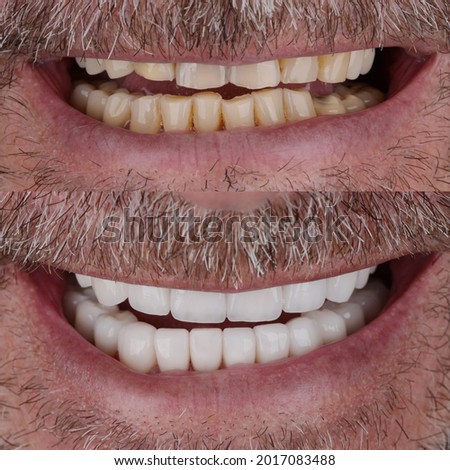 smile after complete smile makeover or full mouth rehabilitation with all ceramic crowns, veneers, bridges.