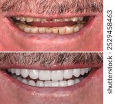 Smile design treatment in aesthetic dentistry with laminate veneers, porcelain crowns, and dental implants. Smile makeover dental before and after.