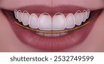 Smile design treatment applied to a woman with beautiful lips in aesthetic dentistry. Digital smile design and smile makeover with E-max and zirconium porcelains for tooth arrangement.