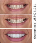 Smile design treatment in dental aesthetic dentistry with laminate veneers and dental crown restorations using computer-aided design. Dental design treatment, before-and-after, and digital design.