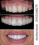 Smile design treatment and smile makeover with porcelain laminates to restore teeth and dental alignment in dental aesthetic dentistry. Dental before after with computer aided dental design.

