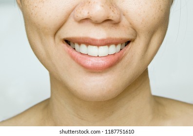 Smile Dimples On Asian Woman Cheek With Freckles Skin