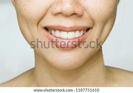 Smile Dimples on Asian Woman Cheek with Freckles Skin