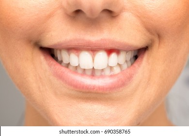 Smile Of Girl With Bleeding Gums