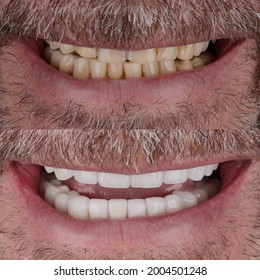 Smile Make Over To Hollywood Smile On Male Patient, Before And After Shot From Front View.