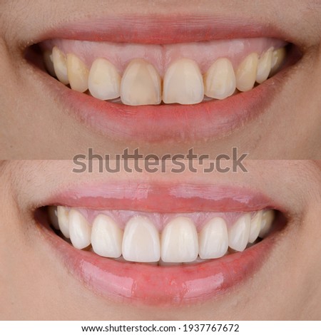 Smile makeover before and after, gummy smile correction and ceramic veneers treatment.