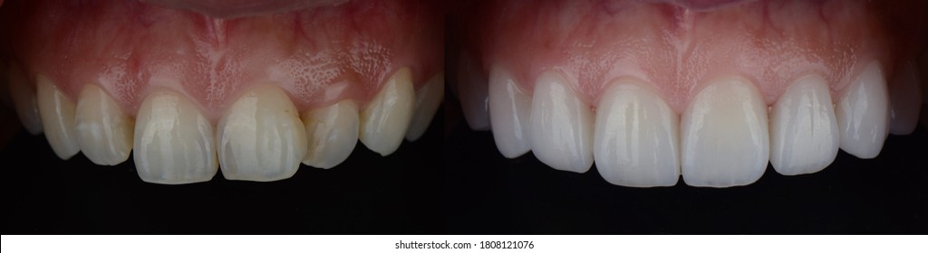 Smile makeover with dental ceramic veneers treatment treating yellow and crooked teeth, result in clean, perfect, youth and white teeth smile. Before and after close up full mouth.