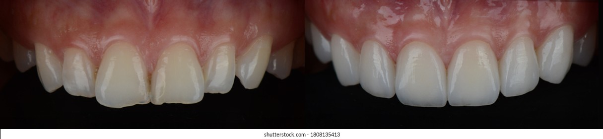 Smile Makeover With Dental Ceramic Veneers Treatment Treating Yellow And Crooked Teeth, Result In Clean, Perfect, Youth And White Teeth Smile. Before And After Close Up Full Mouth.