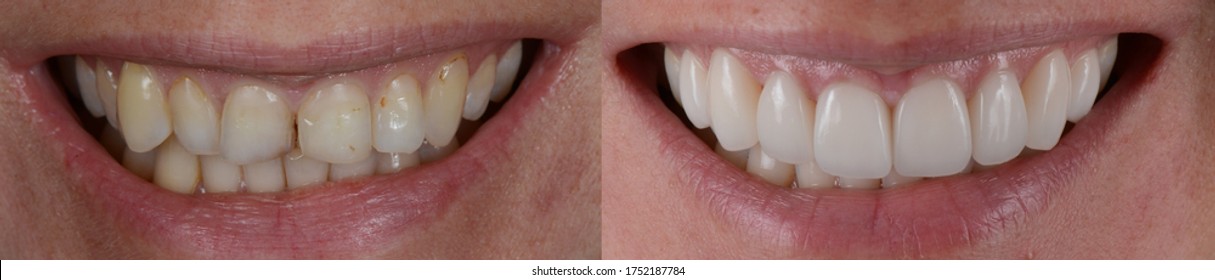 Smile makeover with porcelain laminated veneers, before and after.