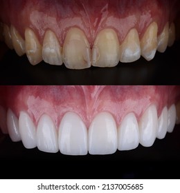 Smile Makeover With Porcelain Laminated Veneers Result In Perfect Smile And Hollywood White Color.