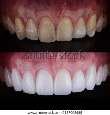 Smile makeover with porcelain laminated veneers result in perfect smile and Hollywood white color.