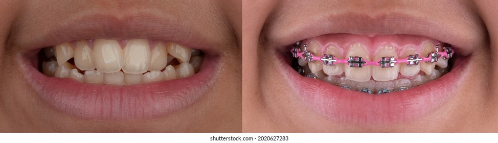 Smile of metal braces treatment, conventional bracket and metal wire to straighten the teeth. Before and after serial shot. - Shutterstock ID 2020627283