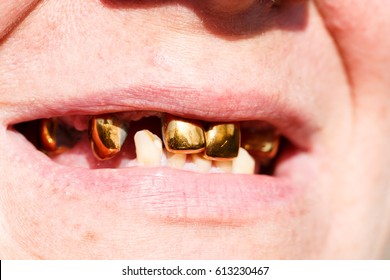 Gold Teeth Images, Stock Photos & Vectors | Shutterstock
