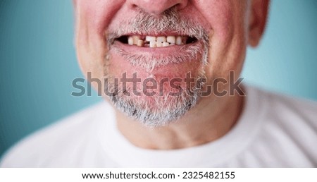 Smile With Missing Tooth. Broken Tooth Absence
