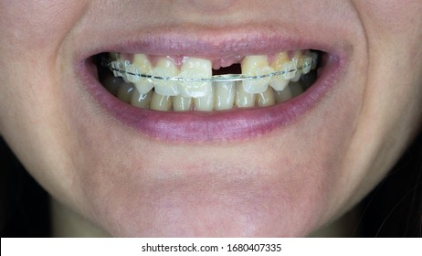 Smile Of A Young Woman Without One Front Tooth. Smile Without Upper Left Unit Teeth. Tooth Model With Metal Wire Dental Brace. 