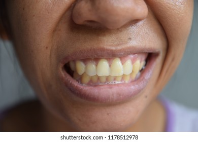 smiled half  Asian female face that show yellow teeth