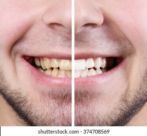 Smiling man: before and after concept