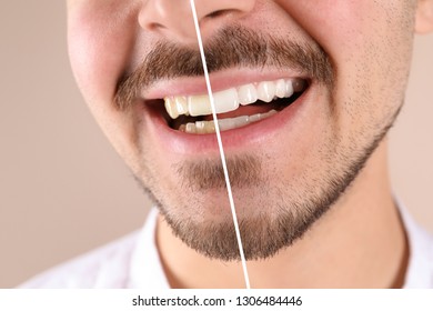 Smiling Man Before And After Teeth Whitening Procedure On Color Background, Closeup