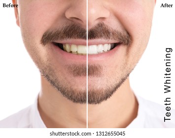 Smiling Man Before And After Teeth Whitening Procedure On Light Background, Closeup