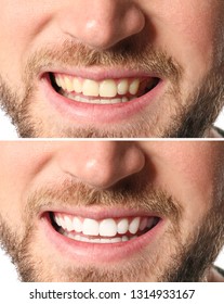 Smiling Man Before And After Teeth Whitening Procedure, Closeup