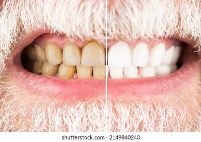 Smiling man before and after teeth whitening procedure, closeup. Close-up Of A Smiling man Teeth Before And After Whitening. Male teeth before and after whitening, oral care dentistry, stomatology.