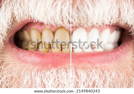 Smiling man before and after teeth whitening procedure, closeup. Close-up Of A Smiling man Teeth Before And After Whitening. Male teeth before and after whitening, oral care dentistry, stomatology.