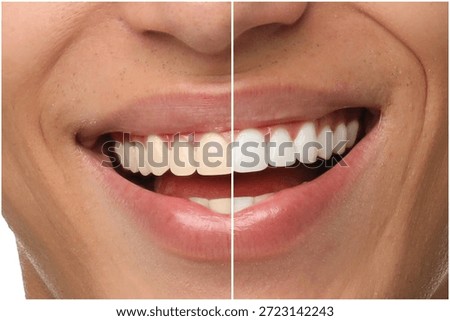 Smiling man before and after teeth whitening treatment, closeup. Collage divided in halves