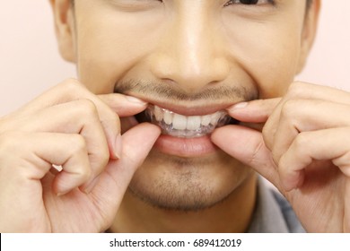 Smiling Man With Silicone Trainer Close Up For More Whitening Teeth, Holding Invisible Braces. Home Whitening Or Bleaching Gel Tray Opalescence.