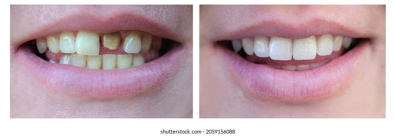 Smiling Woman With A Bad Tooth Before And After Treatment. Close-up. Veneers, Whitening, Building. Collage