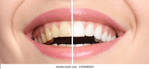 18,204 Dental bleaching Images, Stock Photos & Vectors | Shutterstock