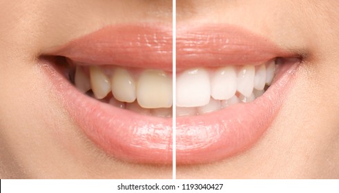 Smiling woman before and after teeth whitening procedure, closeup