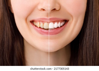 Smiling woman before and after the teeth whitening procedure, close-up image. - Shutterstock ID 2177305143
