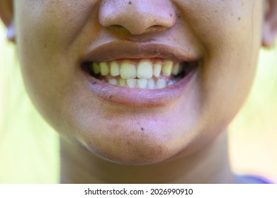 Smiling Woman.Open Mouth. See Teeth.See Teeth That Are Not Aligned.Unattractive Smile