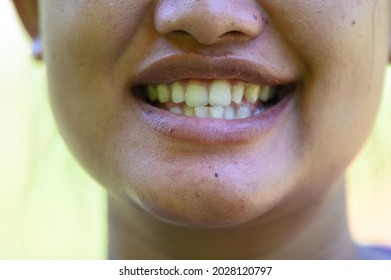 Smiling Woman.Open Mouth. See Teeth.See Teeth That Are Not Aligned.Unattractive Smile