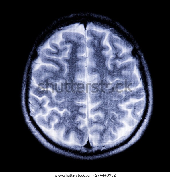 Snapshot of the brain in cross section in\
magnetic resonance\
imaging