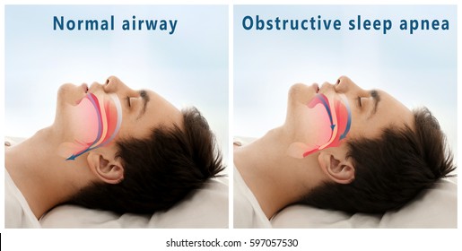 Snore problem concept. Illustration of normal airway and obstructive sleep apnea - Shutterstock ID 597057530