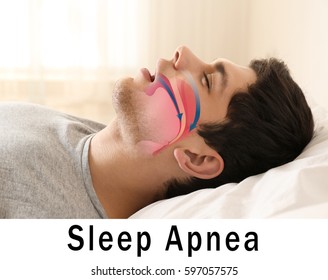 Snore problem concept. Illustration of obstructive sleep apnea - Shutterstock ID 597057575